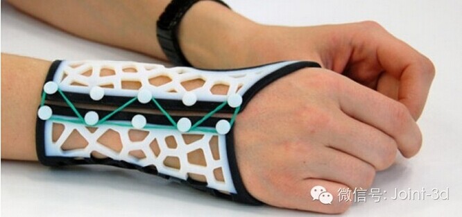 为关节炎患者定制设计的3D打印手腕夹板