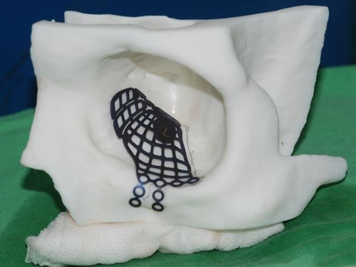 3D打印钛金属骨板，取代病人眼眶底碎裂骨头